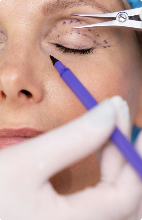 Blefaroplastia