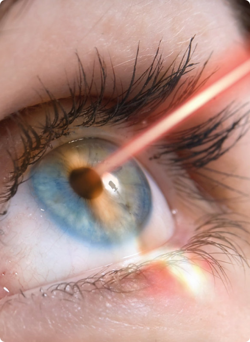 Cirurgia Refrativa